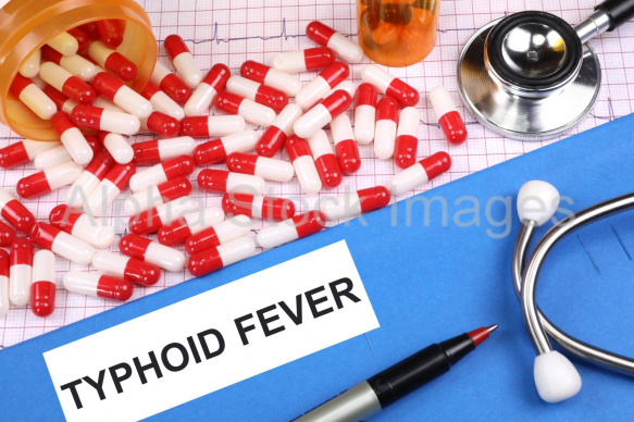 typhoid fever