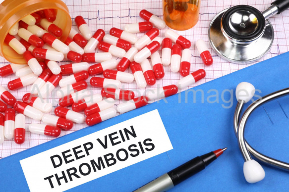 deep vein thrombosis