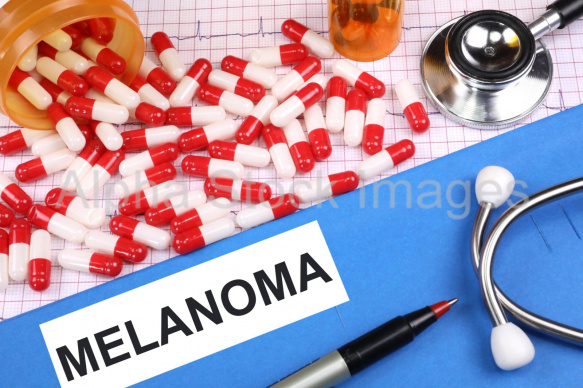 melanoma