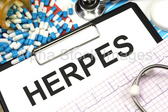 herpes