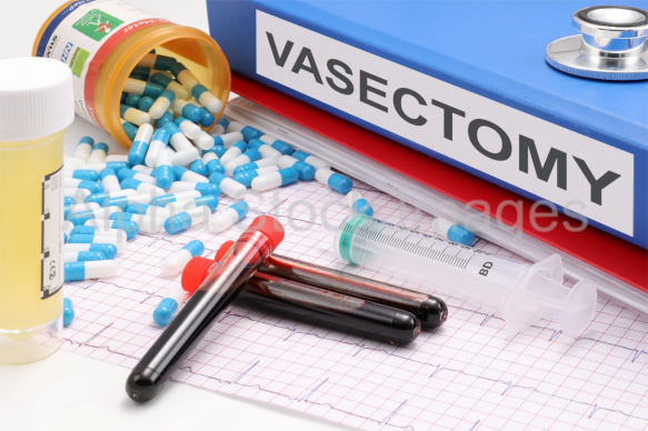 vasectomy