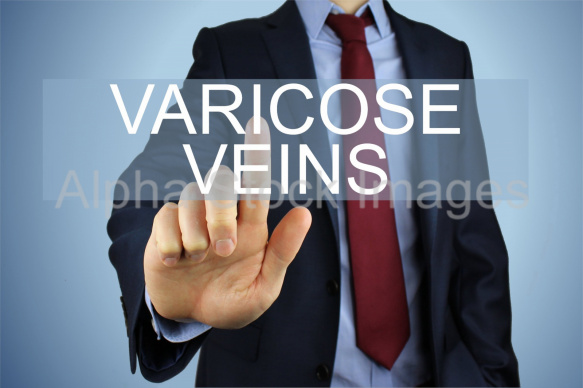 varicose veins