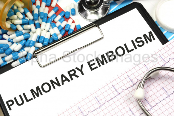 pulmonary embolism