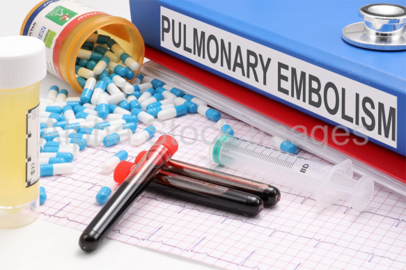 pulmonary embolism