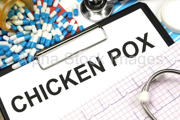 chicken pox