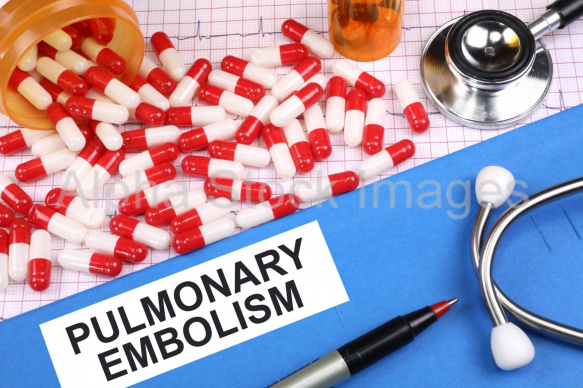 pulmonary embolism