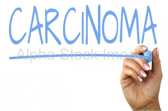 carcinoma