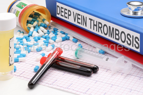 deep vein thrombosis