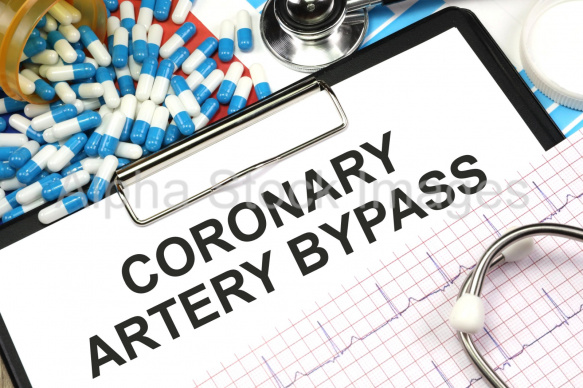 coronary artery bypass