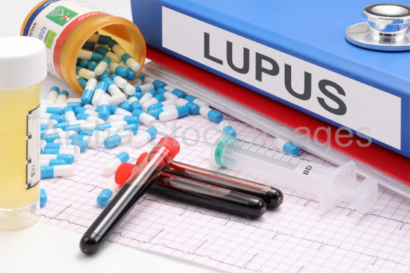 lupus