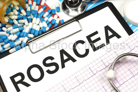 rosacea