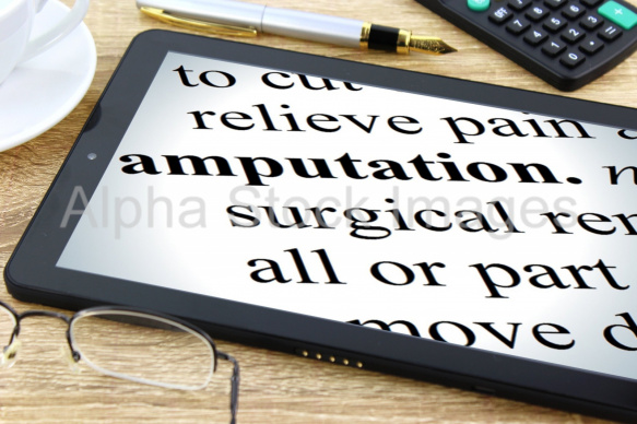 amputation