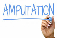 amputation