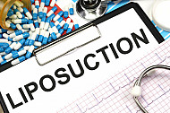 liposuction