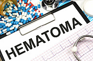 hematoma
