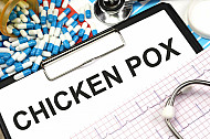 chicken pox
