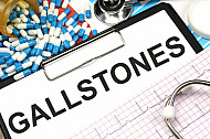 gallstones