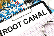 root canal