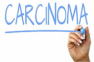carcinoma